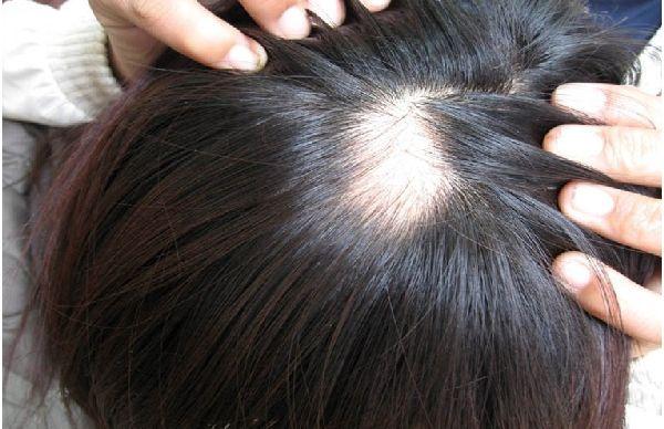 秋冬应对脱发<em>小偏方</em>_圈子话题_快速问医生
