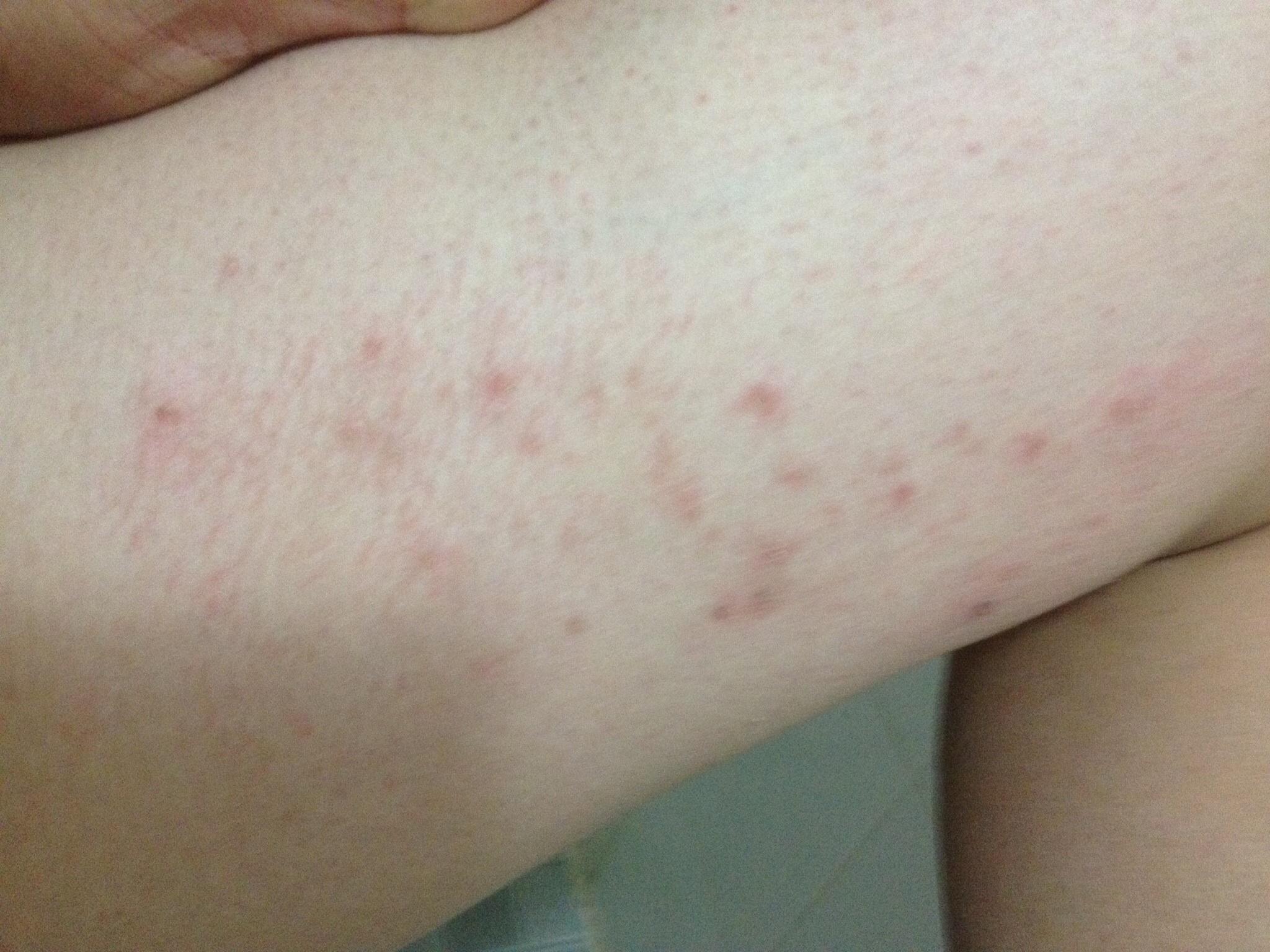大腿内侧老是反复发作,每次好了隔一段时间就又发,这是什么皮肤病阿