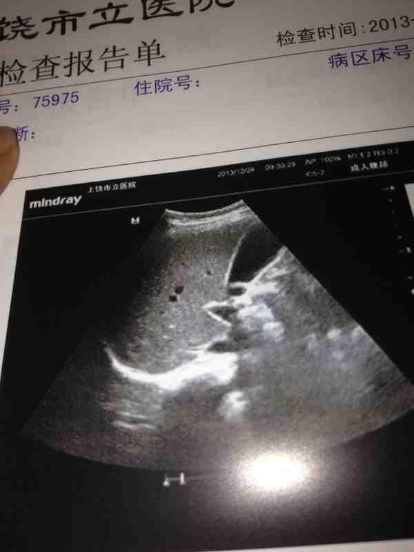 这样的肝脏正常吗  谁看的懂