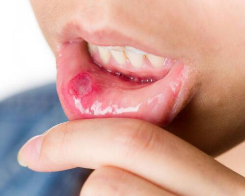 口腔一旦出现这4个异常 小心口腔癌 不能忽视了